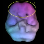 ADHD 2 - - Neuromedis Tip 1 – Klasični add (ADHD)