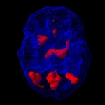 Tip 5 – Limbični ADD