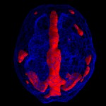 ADHD 4 - - Neuromedis Tip 3 – Prefokusirani add