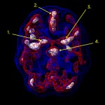Na sliki vidimo zvišano možgansko aktivnost v levem in desnem predelu bazalnih ganglijev, v limbičnem predelu in v anteriornem girusu.